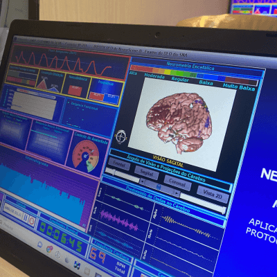 Neurometria funcional